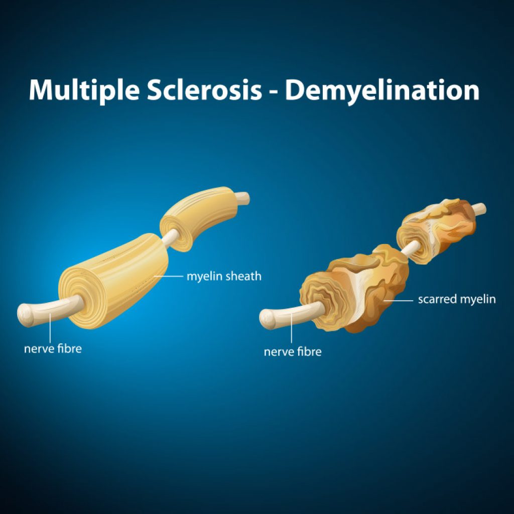 What is Multiple Sclerosis (MS) - MS Australia